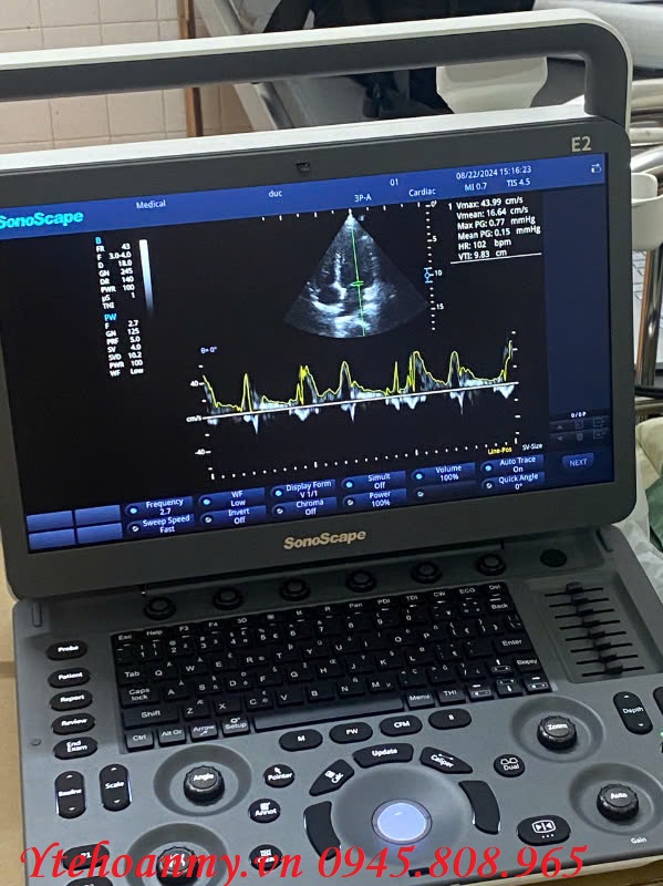 Top 7 máy siêu âm xách tay Doppler màu chất lượng cao - Giá cả hợp lý